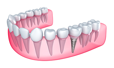 Dental Implants Erie PA